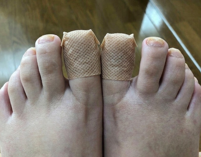 발톱 붙이는 무좀 패치 두껍고 노란 발톱 사용 변화 후기