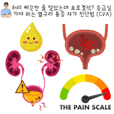 허리 삐끗한 줄 알았는데 요로결석? 응급실 가야 하는 옆구리 통증 자가 진단법 (CVA)