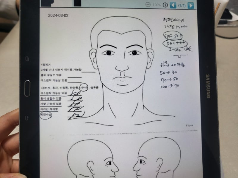 편평사마귀 율무팩 만들어 없애려다 켈로이드 흉터생겨서 레이저 후기 재발 여부
