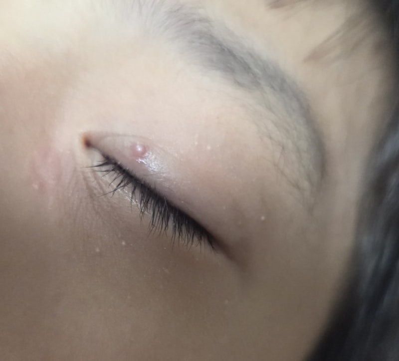 비립종 원인 비렌느 스팟 엑스 효과 있을까? 직접 사용해봄