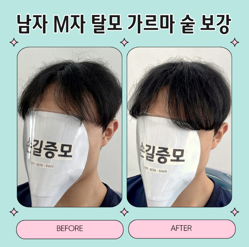 남자 M자 탈모 가르마 숱 보강, 한올증모술 후기