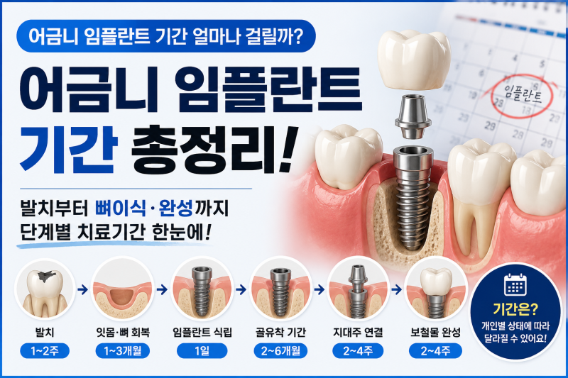 어금니 임플란트 기간 얼마나 걸릴까? 발치부터 뼈이식·완성까지 총정리
