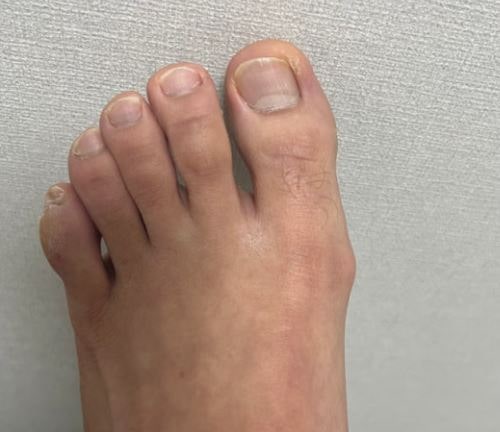 "엄지발가락 골절인데 깁스가 필요할까? 손상 정도에 따른 치료 차이"