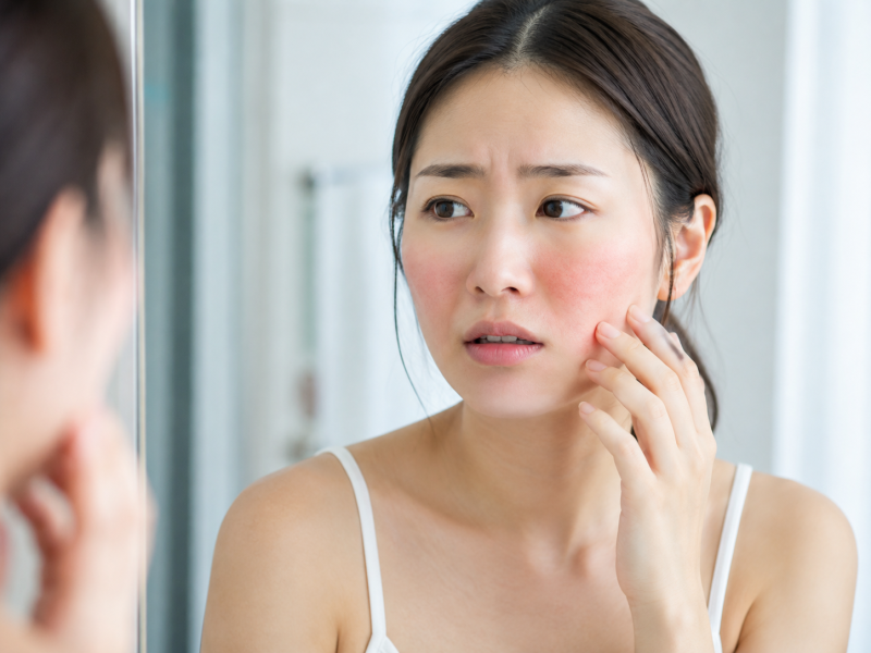 아젤리아크림 따가움, 참고 바르면 되나? 반응이 갈리는 기준