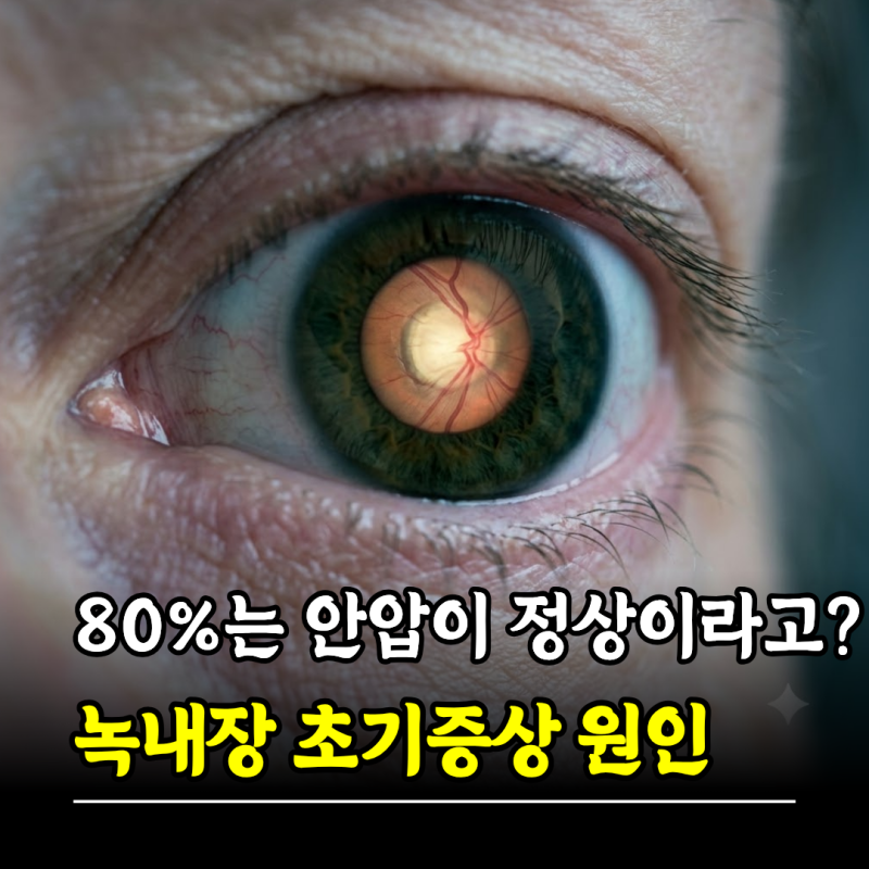 "80%는 안압이 정상이라고?" 녹내장 초기증상 원인 치료