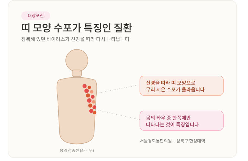 성북구 대상포진 예방주사 맞았는데도 걸리나요? 치료·입원 안내