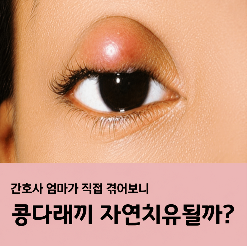 콩다래끼 자연치유, 그냥 두면 없어질까? 간호사가 겪어본 관리방법