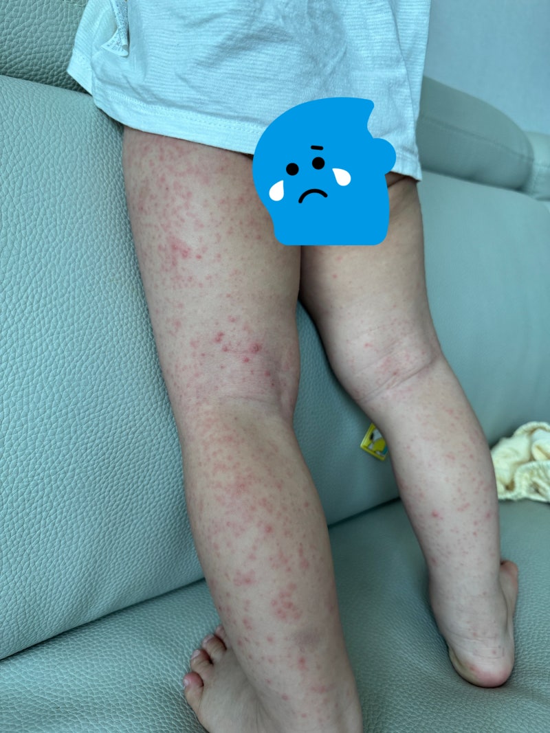 20개월 아기 수족구 후기 | 두 달 만에 재감염, 고열 ·전신 수포·발진과 심한 가려움