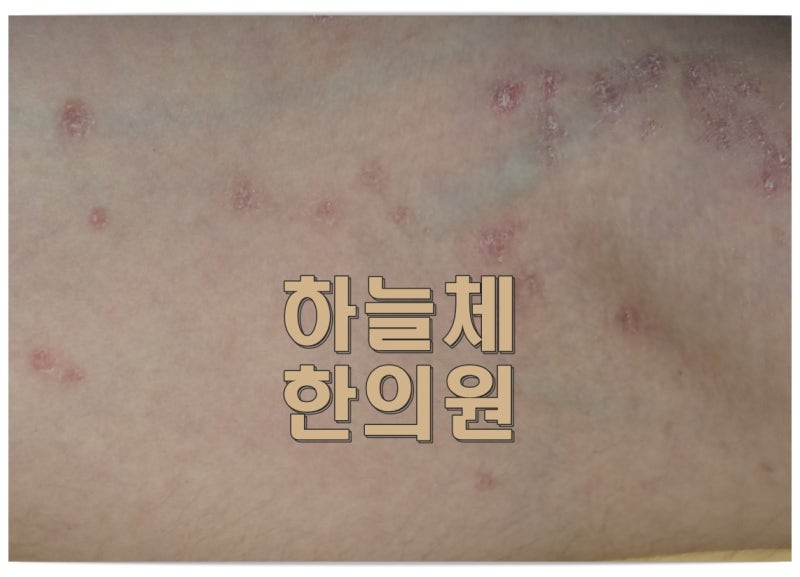 대전 건선 피부과질환, 피부 교체 속도에서 시작해 치료 방향까지 연결해보기