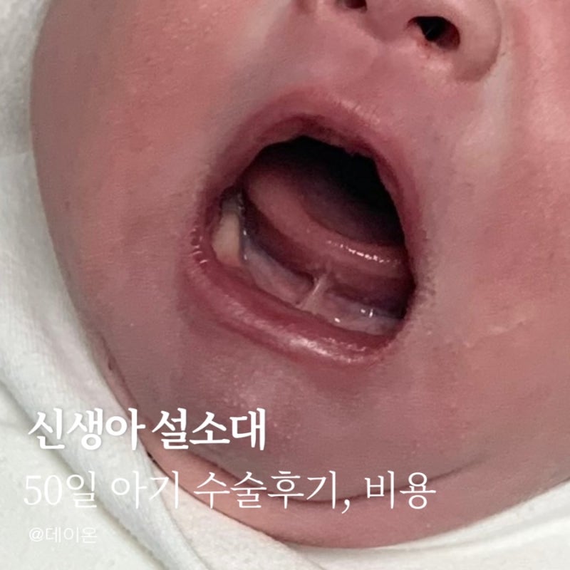 신생아 설소대 수술, 시기 | 50일 아기 수술후기