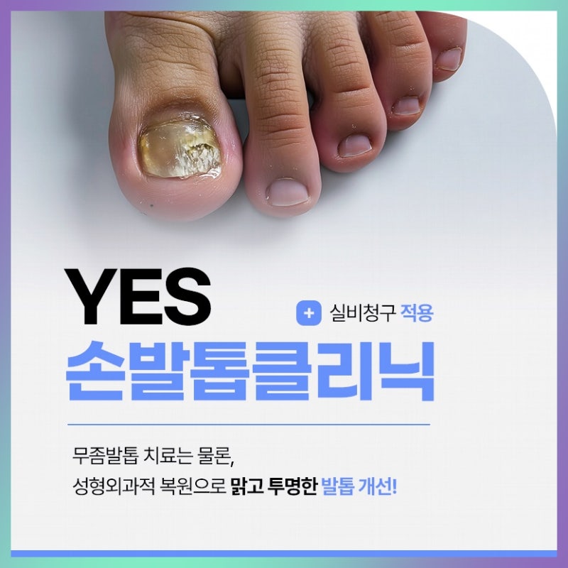 인천발톱무좀 치료 병원 찾는다면, 두꺼워진 발톱부터 확인해봐야