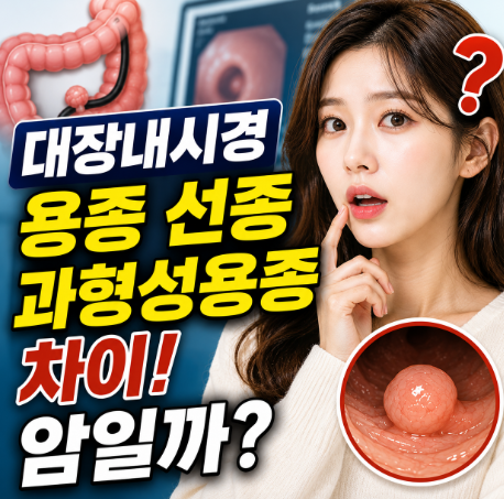 대장내시경 용종 선종이면 암일까? 조직검사 결과 보는 법