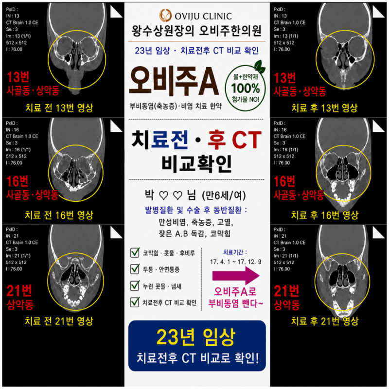 부비동염 수술 안해도 부비동염치료할수 있어요(전두동염 사골동염 접형동염 상악동염) 만....
