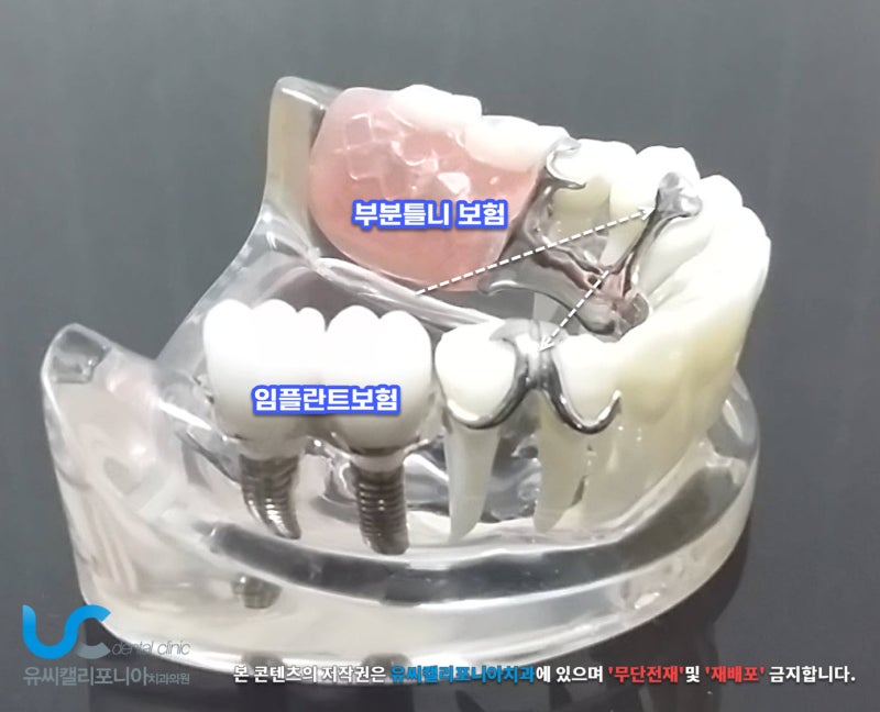 노인 임플란트 틀니 가격 지원 의료급여 본인부담 비율 차이는?