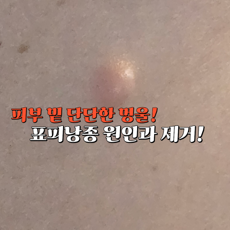 표피낭종 원인과 제거 방법, 무조건 짜면 안 되는 이유