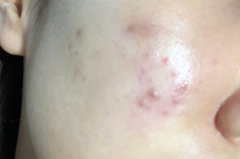 이소티논 5년 장기복용 후기｜여드름 효과, 부작용, 간수치, 술, 음주 (결론 : 계속 먹을 예정)
