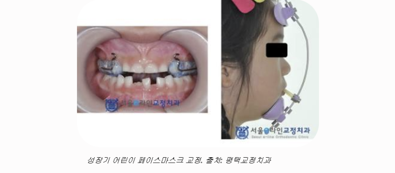[서울·수도권 어린이 교정] 주걱턱 개선하는 페이스마스크 치료법: 시기, 비용, 성인 후 예후....