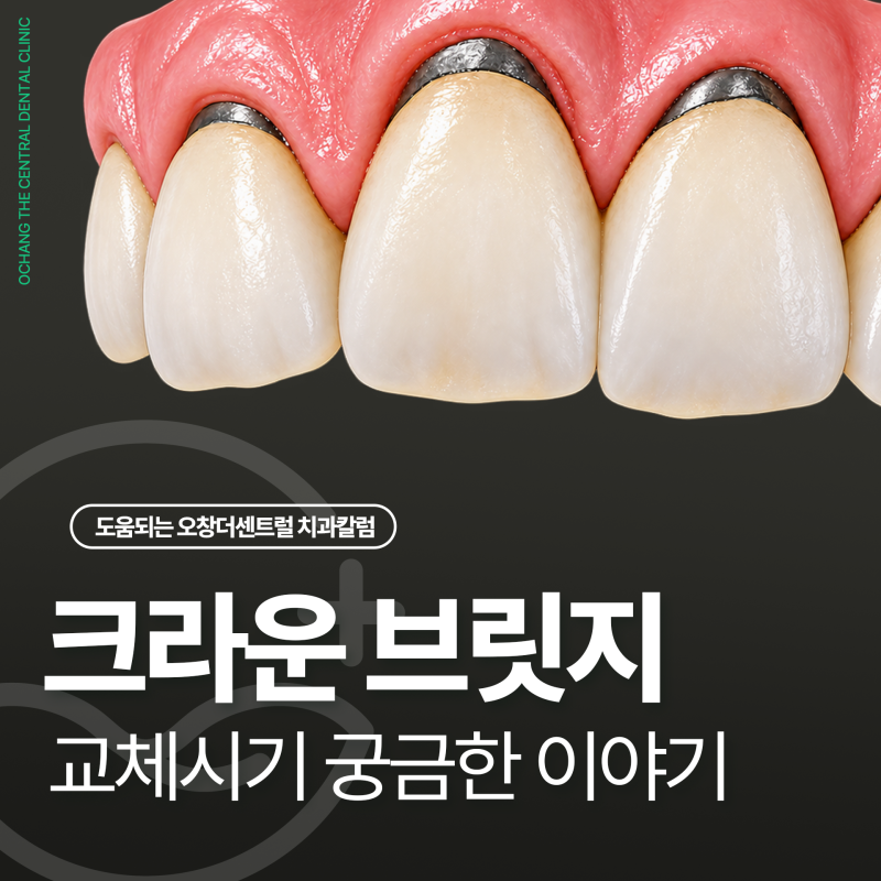 크라운 브릿지 교체 시기, 오래된 보철물에서 확인할 5가지