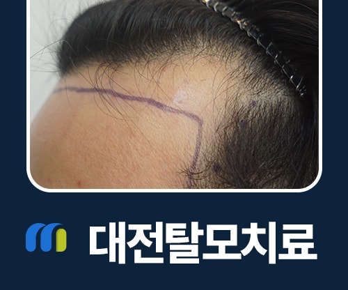 대전탈모치료 후기 찾아볼 때 확인할 모발이식 종류 정리