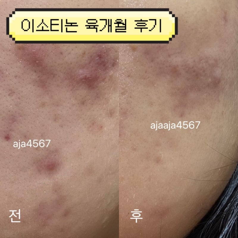 이소티논/트레인(여드름약) 부작용, 복용법, 효과, 6개월 전후 비교 후기