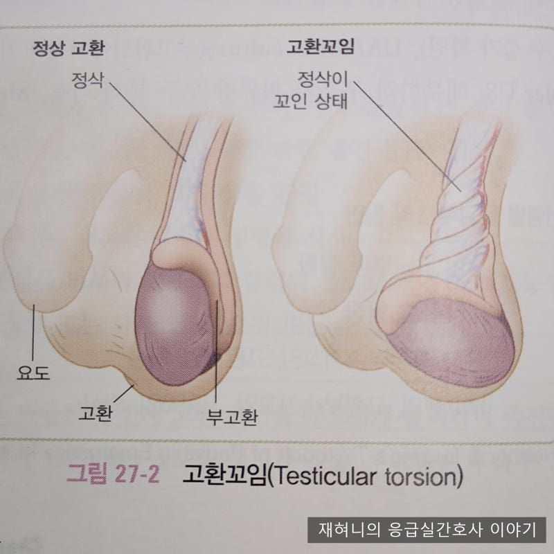 아이가 갑자기 고환이 아파요. 소아 고환염전 증상과 골든타임