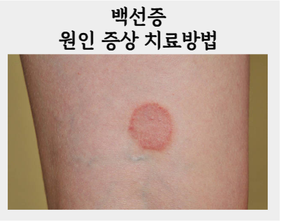 백선증, 동그랗게 번지는 피부 가려움 원인과 한의원 치료