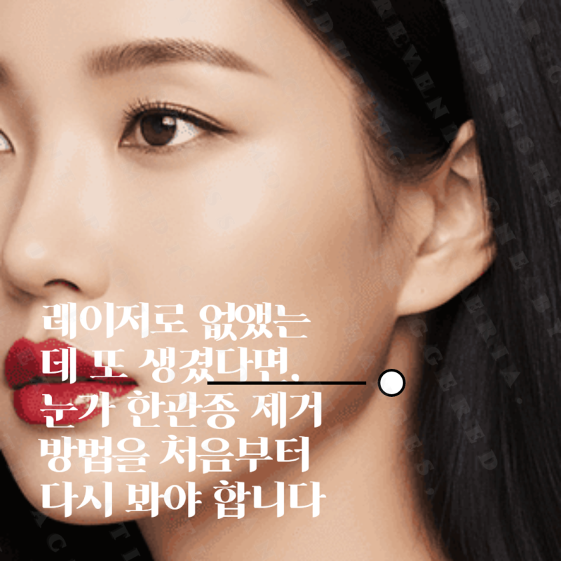 레이저로 없앴는데 또 생겼다면, 눈가 한관종 제거 방법을 처음부터 다시 봐야 합니다