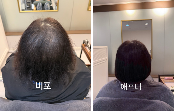 일산탈모성지 어디가 좋을까? 20년 차가 말하는 기준 2가지