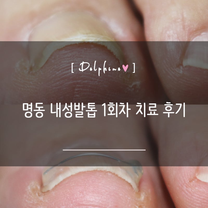 여자 엄지발톱무좀 명동 종로 문제성발톱 내성발톱 치료 교정 1회차 내돈내산 후기