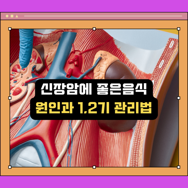 신장암에 좋은 음식과 1기 2기 발병 원인 및 특징 관리법 총정리