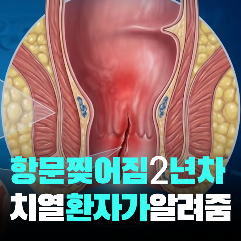 항문 찢어짐 치열 2년 치료 후기