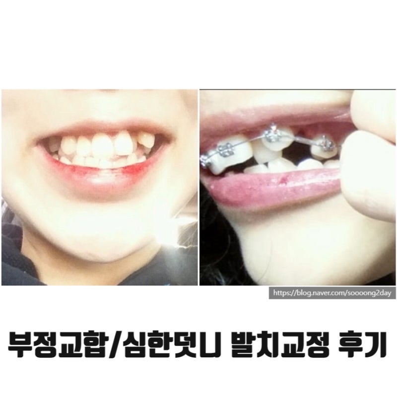 [치아교정 후기.1]부정교합 교정 상담후기 | 심한 덧니 교정 | 발치교정 | 교정통증 리뷰
