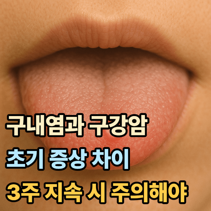 구내염과 구강암 초기증상 차이, 3주 이상 지속된다면 주의하세요