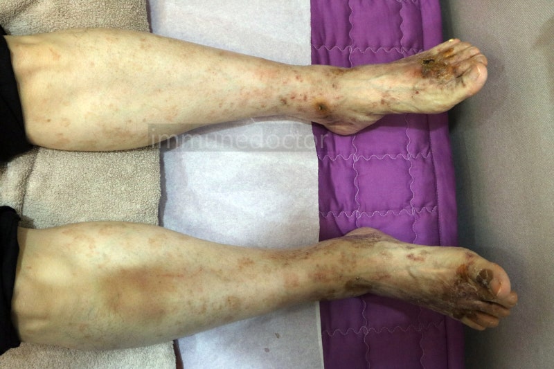 대구자반증, 다리에 나타나는 청피반성 혈관염과 색소성 자반증의 차이