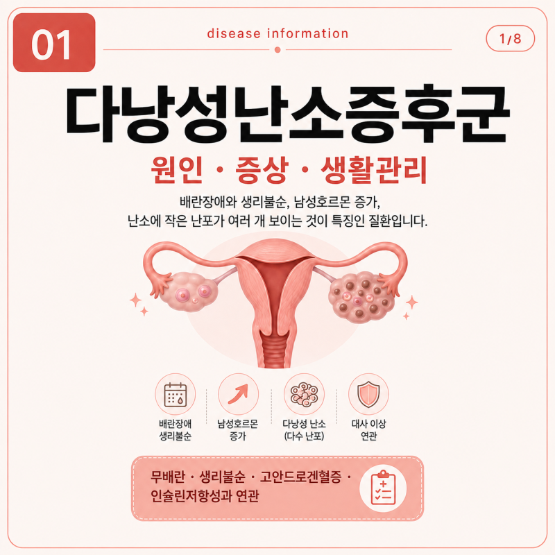 다낭성난소증후군 증상과 원인｜생리불순·여드름·체중 증가, 생활관리는 어떻게?