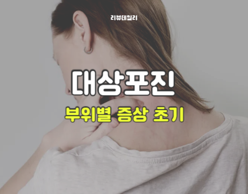 대상포진 증상 초기: 얼굴, 배, 허벅지, 귀, 두피, 허리, 사타구니, 겨드랑이 증상 정리