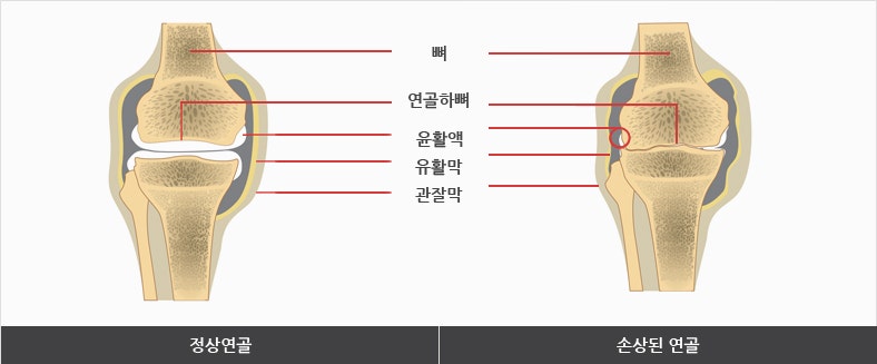 무릎인공관절 수술비 지원조건과 대상 자격,신청서류까지 한 번에 알아보기 총정리