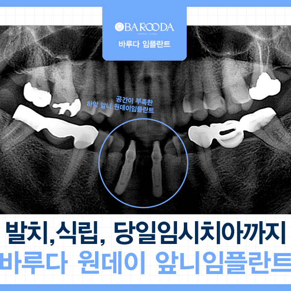 당일임시치아로 식사가 가능한가요? 원데이 바루다 임플란트: 하악 앞니 4개 발치 후 공간을 ....