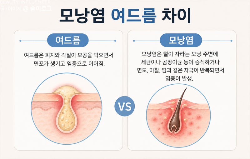 턱 모낭염 원인 증상 가려움 여드름 차이 에스로반 연고 얼굴 모낭충 제거법