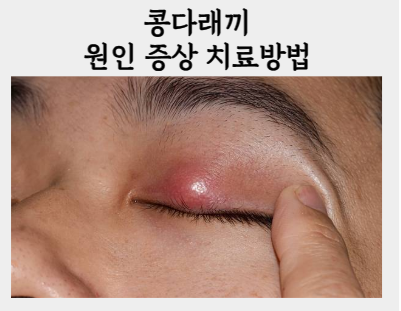 콩다래끼 한의원 치료, 눈꺼풀 멍울 어떻게 관리할까요?