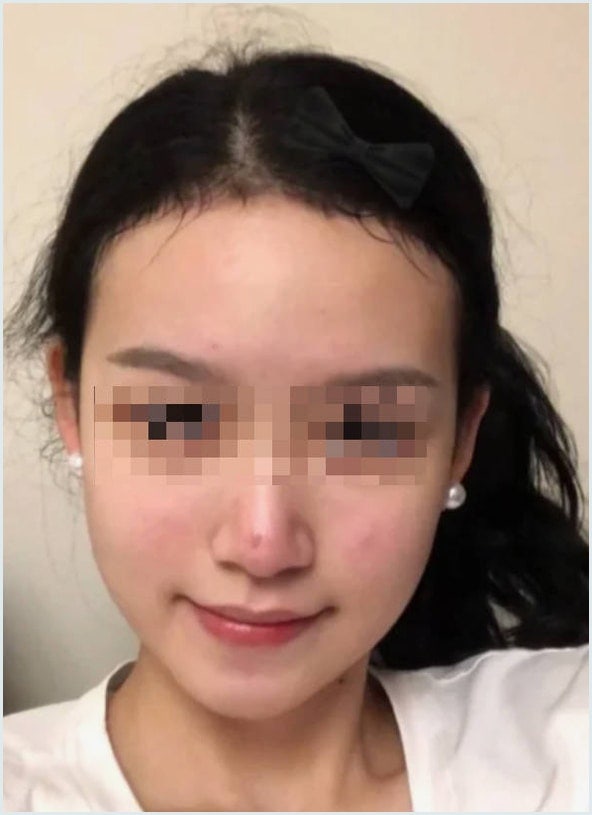 다낭성 난소 증후군 여드름 한 달 후기