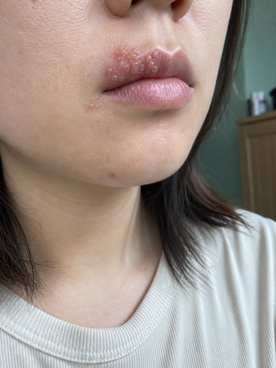입술 헤르페스 연고 입주변 증상 관리법 3가지 핵심 정리