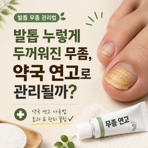 발톱 누렇게 두꺼워진 무좀, 약국 연고로 관리될까?