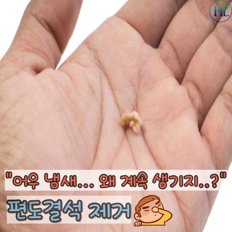 "가글 할까 직접 뺄까?" 편도결석 제거 어떻게 해야 할까?