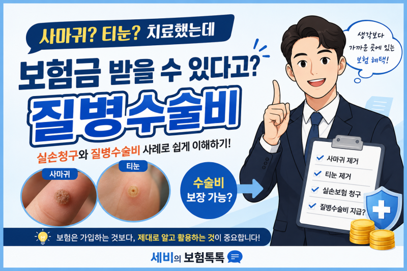 사마귀·티눈 치료했는데 보험금 받을 수 있다고요?