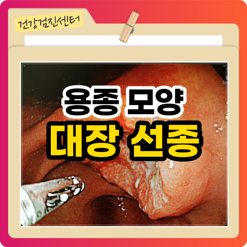 대장 선종 뜻 용종 모양 종류에 따른 암 가능성