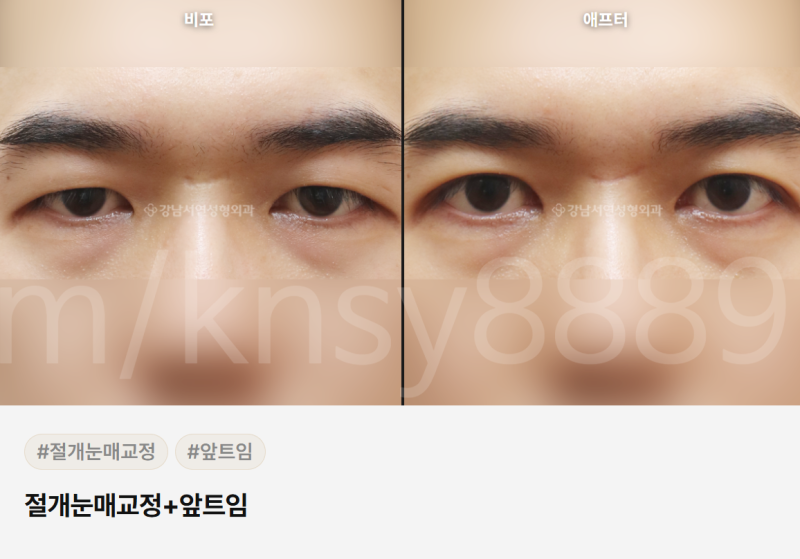 무쌍 눈매교정술, 쌍꺼풀 없이 눈매를 또렷하게 만들 수 있나요?