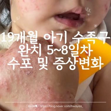아기 수족구 완치 | 5~8일차 격리기간과 등원기준