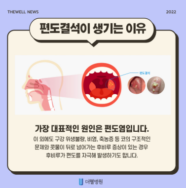 지독한 입냄새 원인, 편도결석일까요? 노년기 구취 관리와 제거 방법