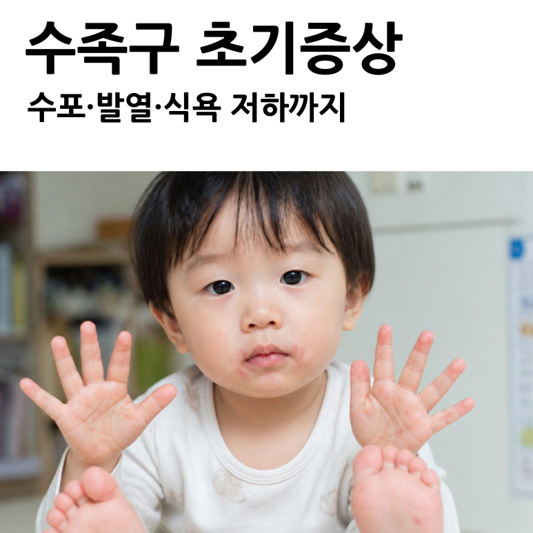 수족구 초기증상 7가지, 수포·발열·식욕 저하까지
